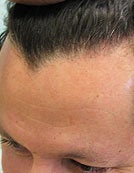 Nape Hair Transplant Patient