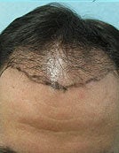 Head FUE and Leg BHT