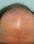 Head and Body FUE SFET Repair
