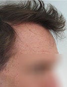 Head and Beard Hair FUE-BHT-SFET to fix follicular unit strip surgery