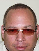 FUE – SFET Using Only Nape and Head Hair for African American Patient