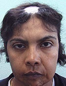 FUE – SFET Using Only Head Hair for Treatment of Lupus