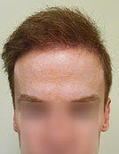 FUE – BHT by SFET Using Body and Head Hair to fix past Scalp Surgery
