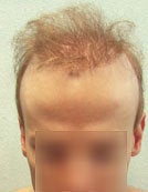 FUE – BHT by SFET Using Body and Head Hair to fix past Scalp Surgery