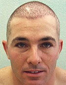 FUE – BHT SFET Using Head and Body Hair to add density