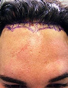 FUE – BHT Using Only Body (Leg) Hair to repair Hair Line