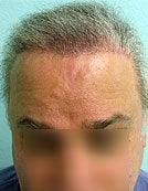 FUE – BHT Using Beard and Body Hair Only 2,000 graft repair using Stomach, Arm, and Leg donor hair