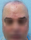 FUE – BHT Using Beard and Body Hair Only 2,000 graft repair using Stomach, Arm, and Leg donor hair