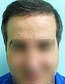 FUE – BHT by SFET Using Only Nape, Head and Body Hair