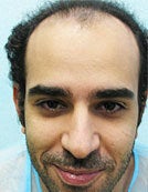 FUE – SFET Using Nape and Head Hair for conservative hairline