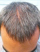 FUE – BHT by SFET Using Only Beard Hair