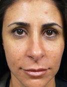 Hydrelle Injection For Treating Laugh Lines or Nasolabial Folds