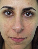 Hydrelle Injection For Treating Laugh Lines or Nasolabial Folds