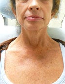 Poikiloderma Treatment with Vbeam