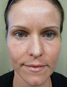 Fraxel Re:pair for Skin Rejuvenation