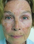 Skin Resurfacing Using Plasma Rejuvenation with Portrait