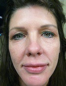 Hydrelle Injection for Treating Laugh Lines or Nasolabial Folds