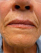 Fraxel Re:pair for Skin Rejuvenation