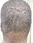 Surgical Treatment of Acne Keloidalis Nuchae