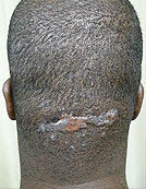 Surgical Treatment of Acne Keloidalis Nuchae