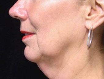 Mini Face-Lift 