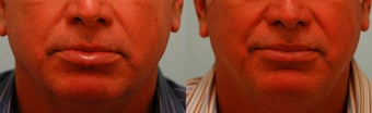 Lower Lip Reduction