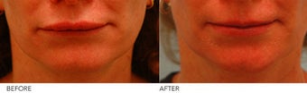 Upper Lip Reduction