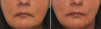 Lower Face Filler