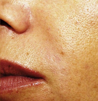 Sculptra