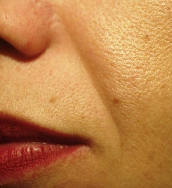 Sculptra