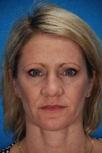 Revision rhinoplasty