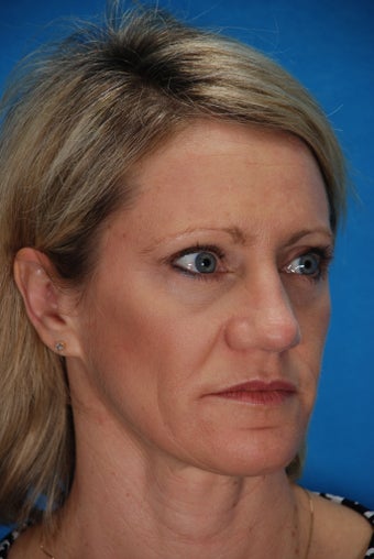 Revision rhinoplasty