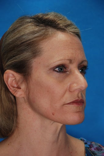 Revision rhinoplasty