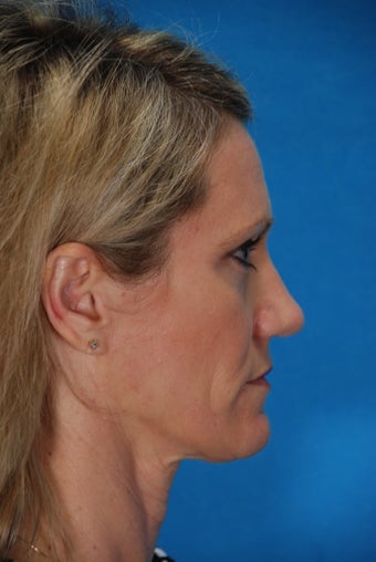 Revision rhinoplasty