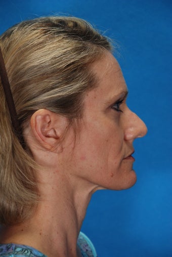 Revision rhinoplasty