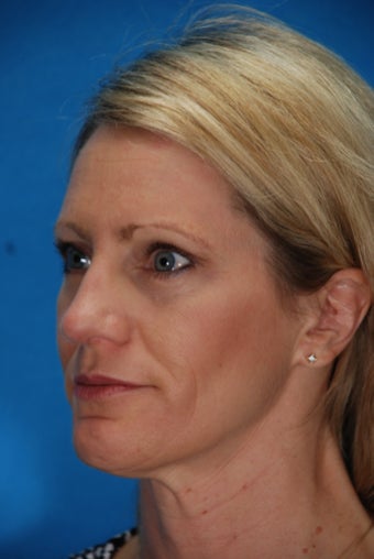 Revision rhinoplasty