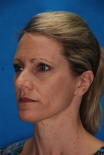 Revision rhinoplasty