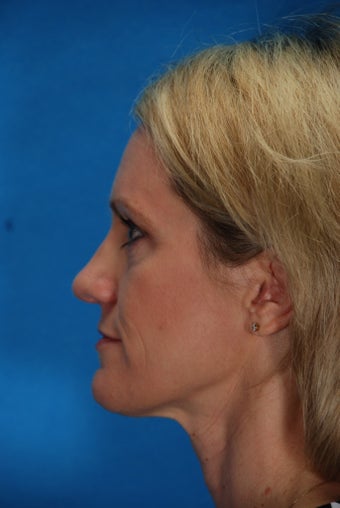 Revision rhinoplasty
