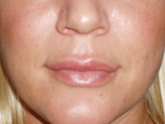 Lip Implants