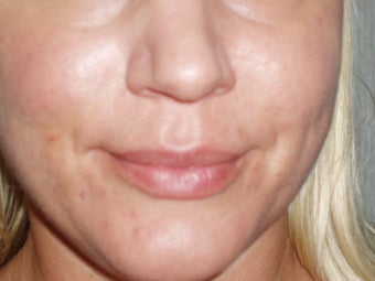 Lip Implants