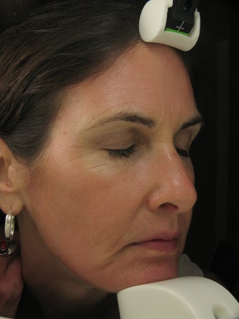 Fraxel Dual Laser for wrinkles around eye, cheeks, forehead