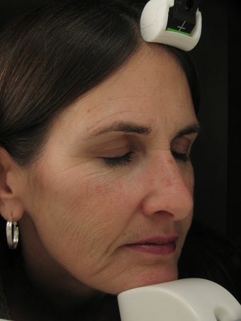 Fraxel Dual Laser for wrinkles around eye, cheeks, forehead