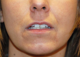 Lip Augmentation