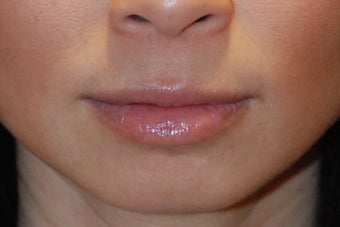 Lip Augmentation