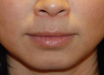 Lip Augmentation