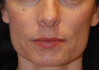 Mole removal 