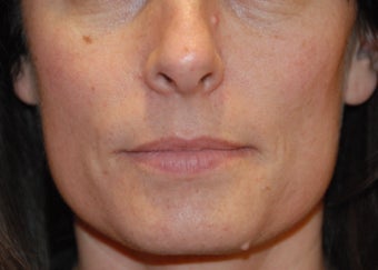 Mole removal 