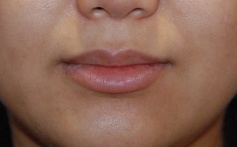 Lip Augmentation
