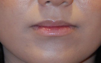 Lip Augmentation