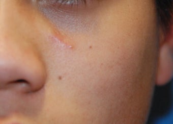 Mole removal 